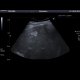 Liver hemangioma: US - Ultrasound