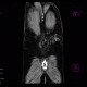 Subcutaneous hemangioma: CT - Computed tomography