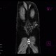 Subcutaneous hemangioma: CT - Computed tomography