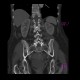 Hemangioma of pelvis and vertebra: CT - Computed tomography
