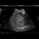 Liver hematoma: US - Ultrasound