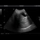 Liver hematoma: US - Ultrasound