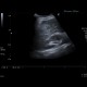 Liver hematoma: US - Ultrasound