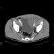Hematoma after repair of inguinal hernia: CT - Computed tomography