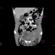 Hematoma after repair of inguinal hernia: CT - Computed tomography