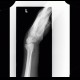 Colles fracture, pronator quadratus, fat pad sign: X-ray - Plain radiograph