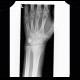 Colles fracture, pronator quadratus, fat pad sign: X-ray - Plain radiograph