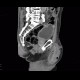 Repair of inguinal hernia, hematoma, mimic of recurrence: CT - Computed tomography