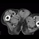 Repair of inguinal hernia, hematoma, mimic of recurrence: CT - Computed tomography