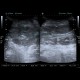 Repair of inguinal hernia, hematoma, mimic of recurrence: US - Ultrasound