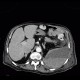 Hematoma in psoas muscle, large, anticoagulation therapy, anticoagulant: CT - Computed tomography