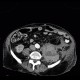 Hematoma in psoas muscle, large, anticoagulation therapy, anticoagulant: CT - Computed tomography