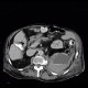 Hematoma in psoas muscle, large, anticoagulation therapy, anticoagulant: CT - Computed tomography