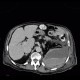 Hematoma in psoas muscle, large, anticoagulation therapy, anticoagulant: CT - Computed tomography