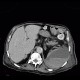 Hematoma in psoas muscle, large, anticoagulation therapy, anticoagulant: CT - Computed tomography