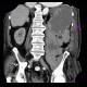 Hematoma in psoas muscle, large, anticoagulation therapy, anticoagulant: CT - Computed tomography