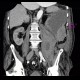 Hematoma in psoas muscle, large, anticoagulation therapy, anticoagulant: CT - Computed tomography