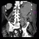 Hematoma in psoas muscle, large, anticoagulation therapy, anticoagulant: CT - Computed tomography