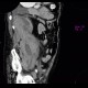 Hematoma in psoas muscle, large, anticoagulation therapy, anticoagulant: CT - Computed tomography