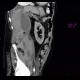 Hematoma in psoas muscle, large, anticoagulation therapy, anticoagulant: CT - Computed tomography