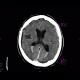 Hemocephalus, subarachonoid hemorrhage, subdural hematoma, brain contusion: CT - Computed tomography