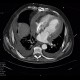 Hemopericardium, perforation of the right atrium: CT - Computed tomography