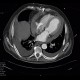 Hemopericardium, perforation of the right atrium: CT - Computed tomography