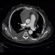 Hemopericardium, perforation of the right atrium: CT - Computed tomography