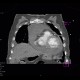 Hemopericardium, perforation of the right atrium: CT - Computed tomography