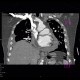 Hemopericardium, perforation of the right atrium: CT - Computed tomography