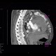 Hemopericardium, perforation of the right atrium: CT - Computed tomography