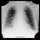 Hemopericardium, aortic valve replacement: X-ray - Plain radiograph