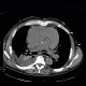 Hemopericardium, aortic valve replacement: CT - Computed tomography