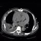 Hemopericardium, aortic valve replacement: CT - Computed tomography