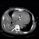 Hemopericardium, aortic valve replacement: CT - Computed tomography