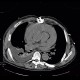 Hemopericardium, aortic valve replacement: CT - Computed tomography