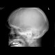 Hemosinus, fracture of maxillary sinus: X-ray - Plain radiograph