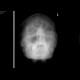 Hemosinus, fracture of maxillary sinus: X-ray - Plain radiograph