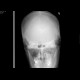 Hemosinus, fracture of maxillary sinus: X-ray - Plain radiograph