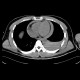 Hemothorax, hemopericardium: CT - Computed tomography