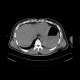 Hemothorax, hemopericardium: CT - Computed tomography