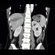 Liver hematoma, hemothorax, stab wound: CT - Computed tomography