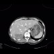 Liver hematoma, hemothorax, stab wound: CT - Computed tomography