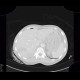 Liver hematoma, hemothorax, stab wound: CT - Computed tomography