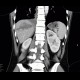 Liver hematoma, hemothorax, stab wound: CT - Computed tomography