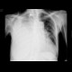 Hemothorax: X-ray - Plain radiograph