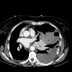 Hemothorax, pneumothorax: CT - Computed tomography