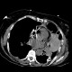 Hemothorax, pneumothorax: CT - Computed tomography