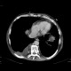 Hepatocellular carcinoma, thrombosis of VCI and right atrium, lung embolism: CT - Computed tomography