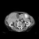 Hepatocellular carcinoma - 3 phase CT scans: CT - Computed tomography